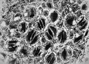 F,69y. | cystadenoma (Warthin tumor) … caruncula - (modified mitochondria in an autolysed sample)